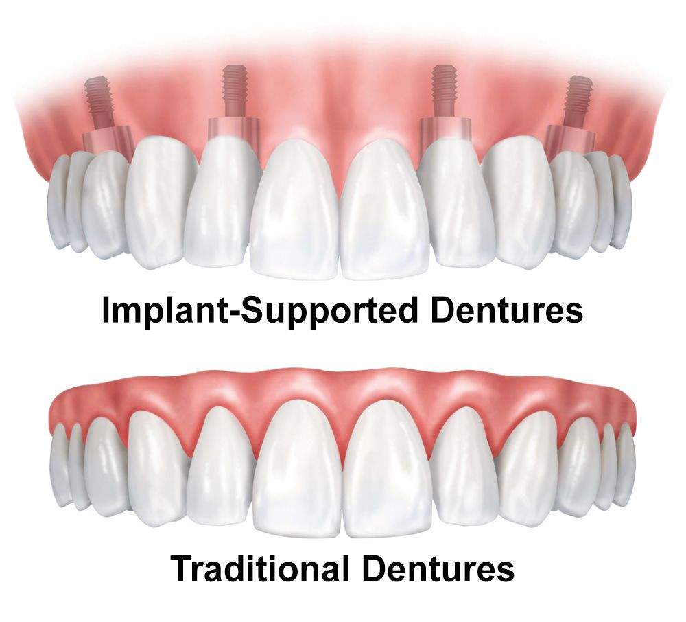 implant dentures