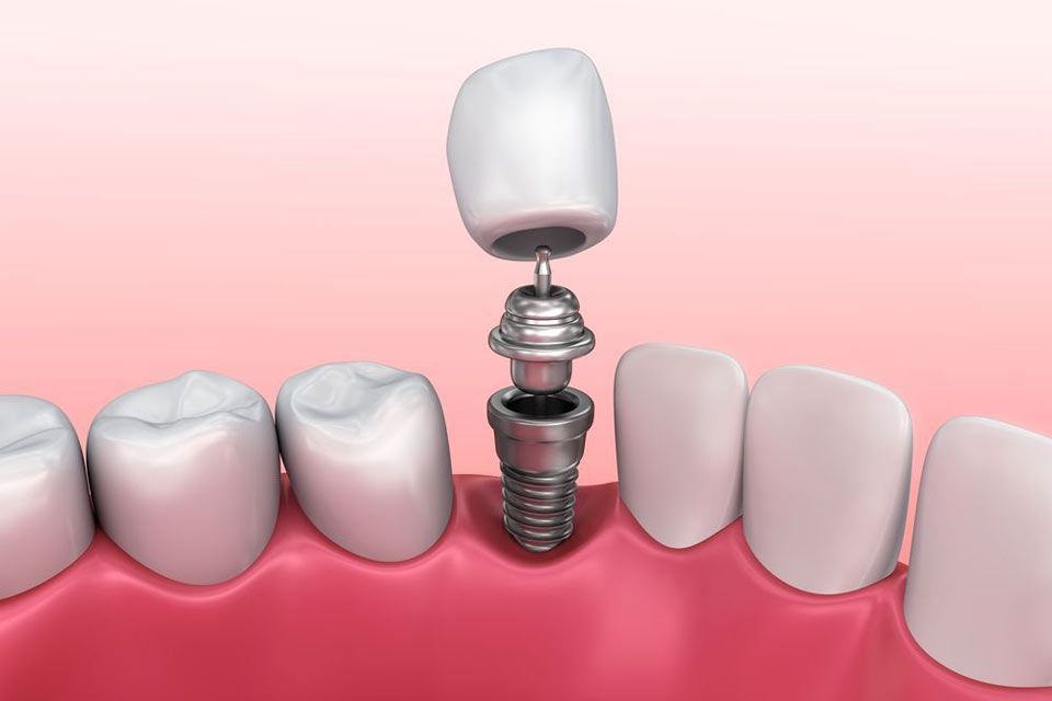 Illustration of dental implant, crown, and abutment
