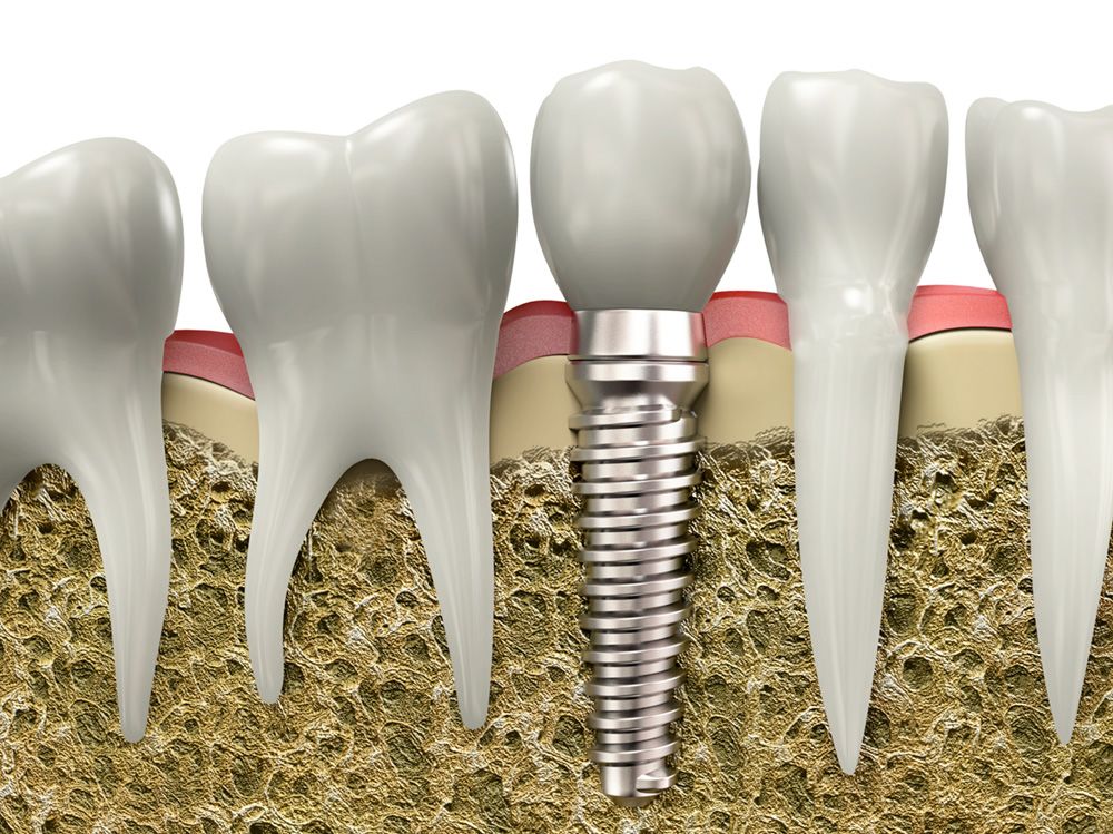 A dental implant anchored into the jawbone next to natural teeth.