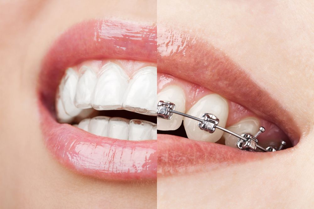 A side by side of a smile with clear aligners and a smile with metal braces